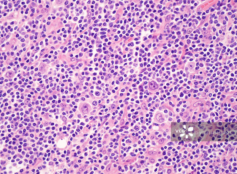 结节性淋巴细胞为主型霍奇金淋巴瘤显微照片图片素材