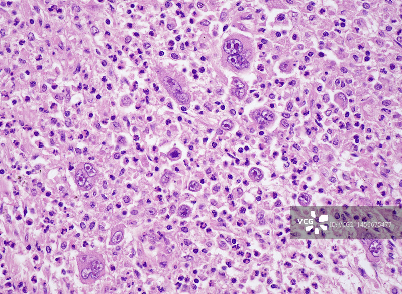 混合细胞型霍奇金淋巴瘤，光学显微照片图片素材