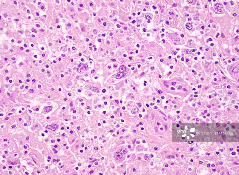 结节性硬化霍奇金淋巴瘤，光学显微照片图片素材