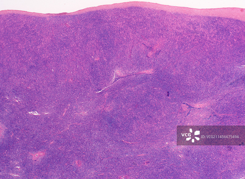 富含淋巴细胞的霍奇金淋巴瘤显微照片图片素材