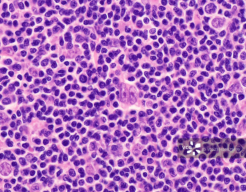 富含淋巴细胞的霍奇金淋巴瘤显微照片图片素材
