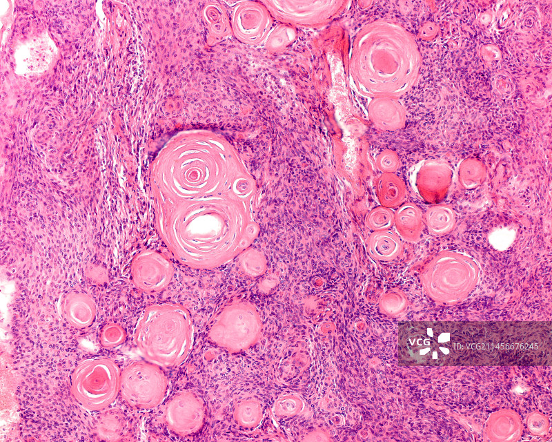 脑膜瘤光学显微照片图片素材