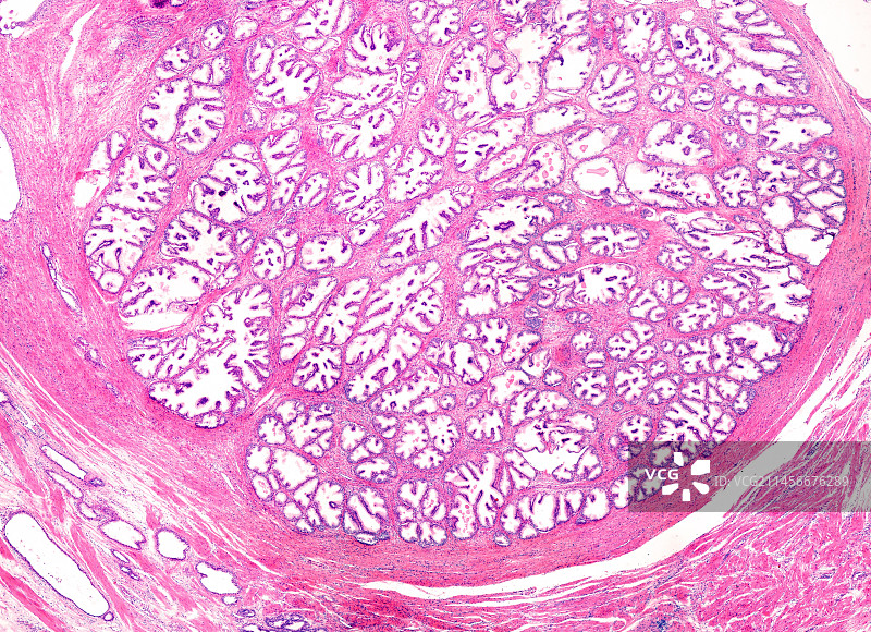 良性前列腺增生，光学显微照片图片素材