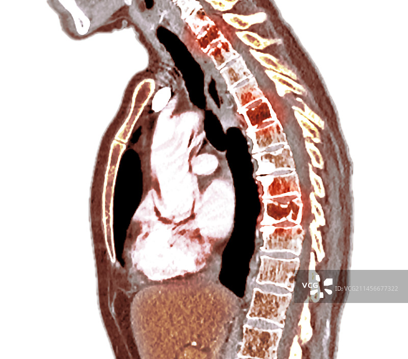 脊柱多发性骨髓瘤CT和MRI扫描图片素材