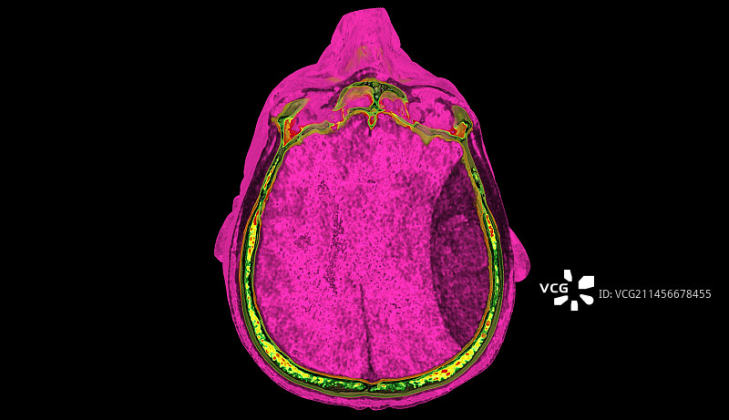硬膜外血肿CT扫描图片素材