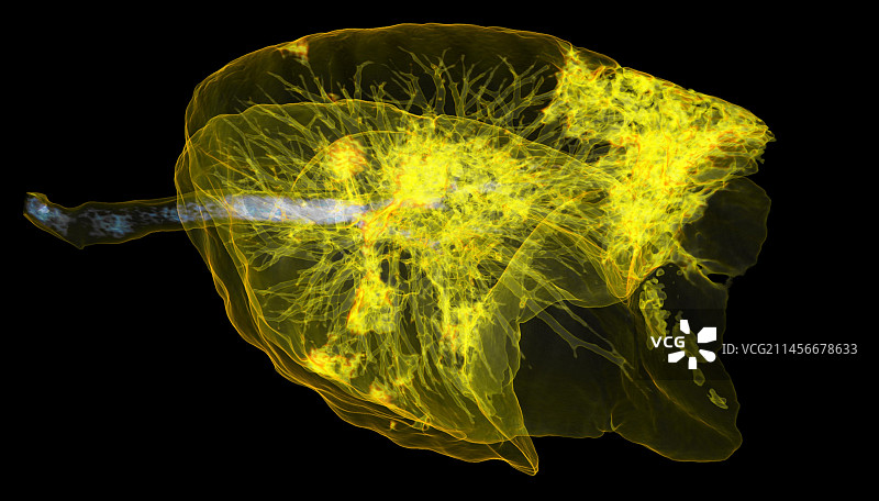 新冠肺炎感染肺部CT扫描图片素材