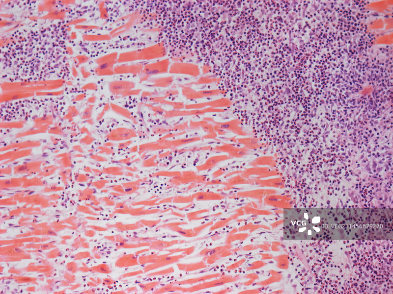嗜酸性心肌炎，LM图片素材