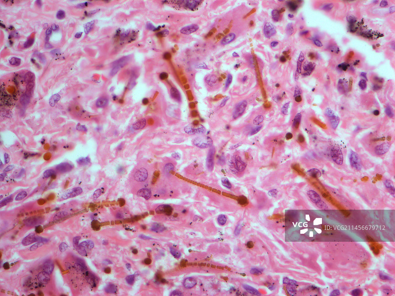 石棉肺病，LM图片素材