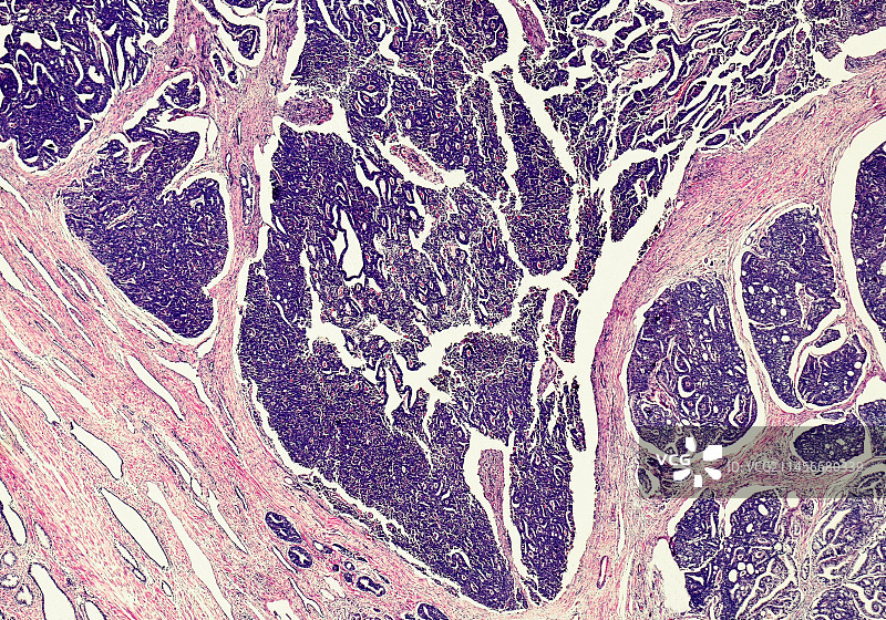 前列腺癌，光学显微照片图片素材