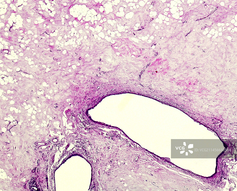 疤痕组织光学显微照片图片素材