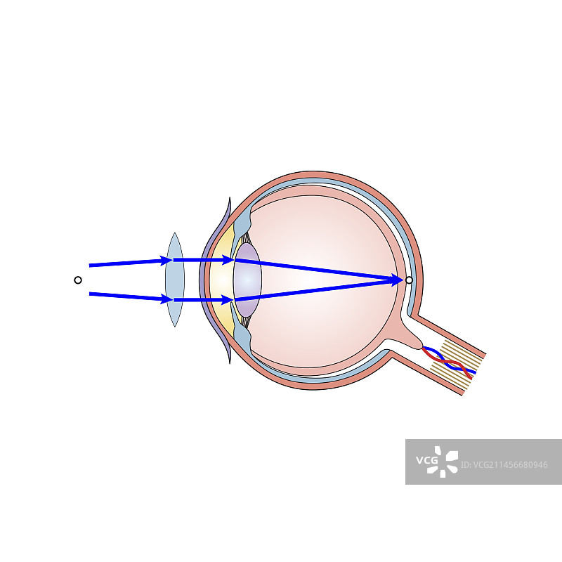 视力矫正插画图片素材