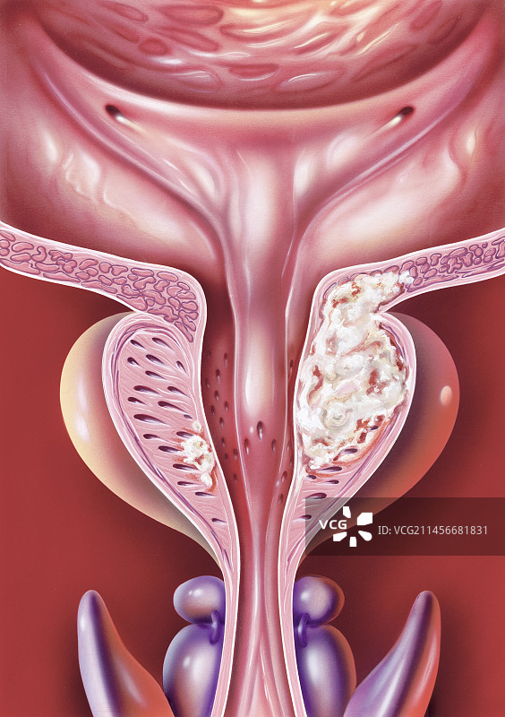 前列腺癌插画图片素材