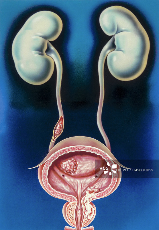 男性泌尿生殖系统癌症图示图片素材