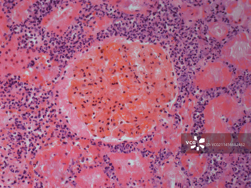 肾脏组织死亡图片素材