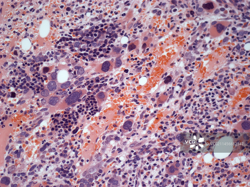 全血细胞减少症，LM图片素材