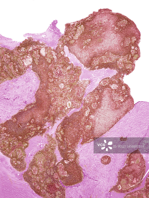 唾液腺癌，LM图片素材