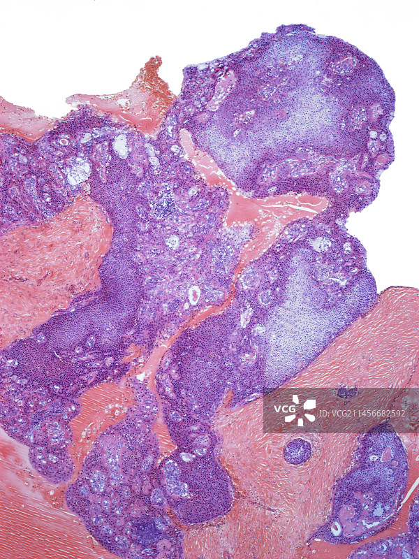 唾液腺癌，LM图片素材
