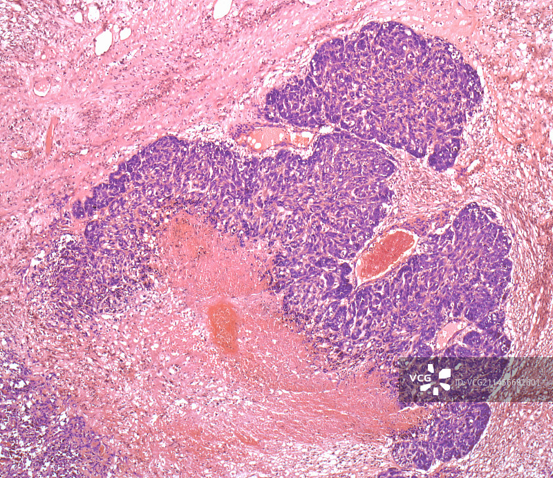 唾液腺癌，LM图片素材