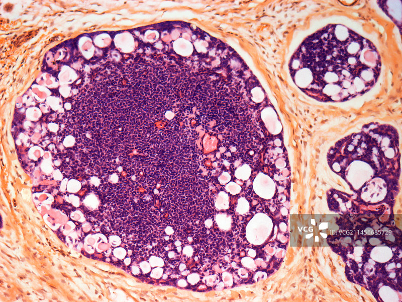 乳腺癌图片素材