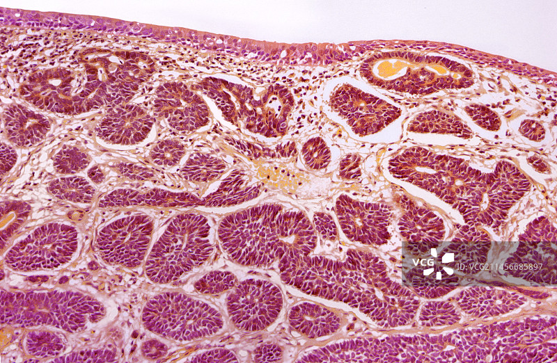 乳腺癌图片素材