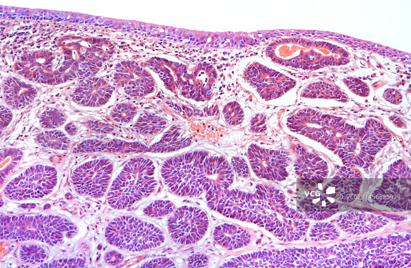 乳腺癌图片素材