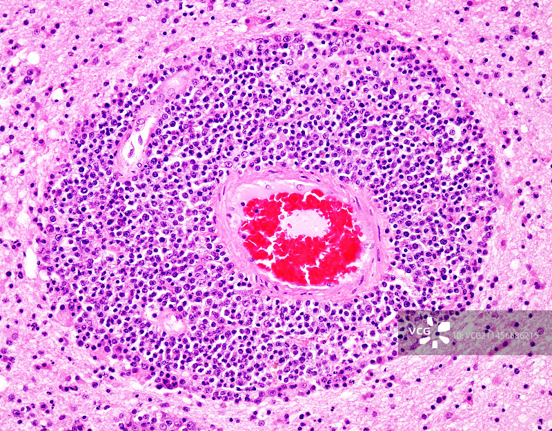 与艾滋病相关的弥漫大B细胞淋巴瘤图片素材