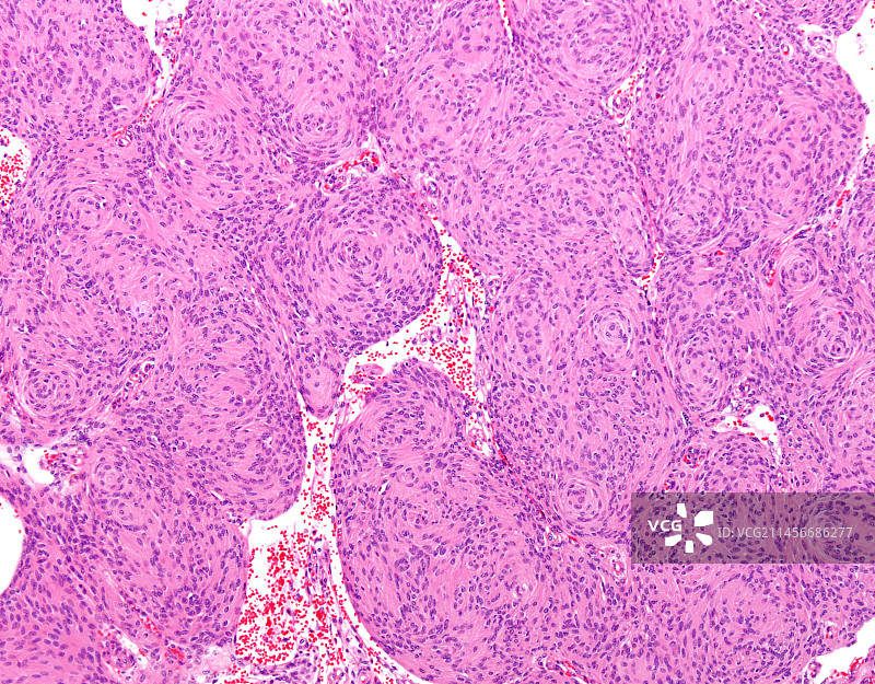 脑膜内皮脑膜瘤，光学显微照片图片素材