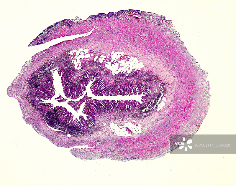 慢性阑尾炎显微照片图片素材