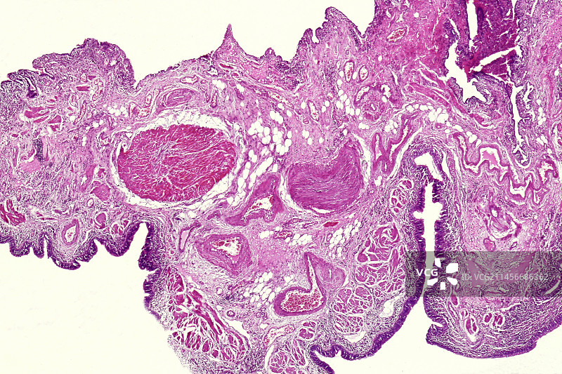 人支气管扩张，光学显微照片图片素材