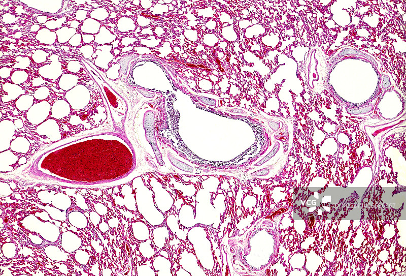 慢性肺水肿显微照片图片素材