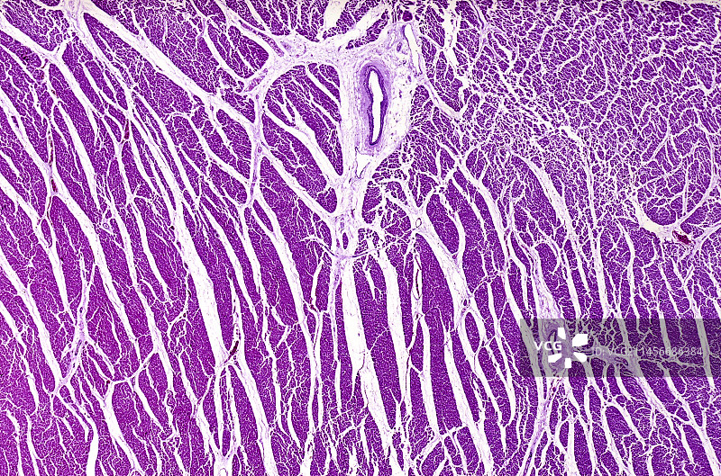 风湿性心内膜炎光学显微照片图片素材