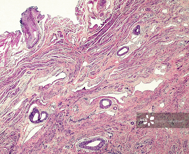 宫颈鳞状细胞化生，光学显微照片图片素材