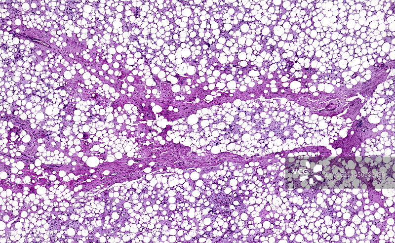 脂肪瘤切片显微照片图片素材
