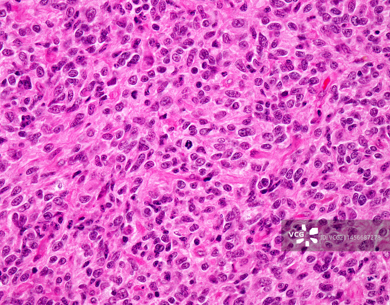 间变性星形细胞瘤，光学显微照片图片素材