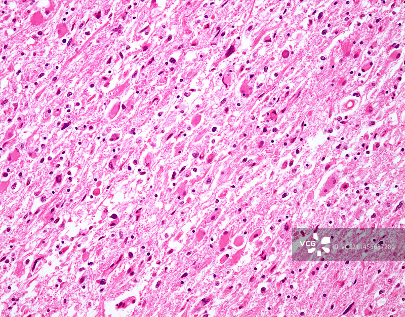 弥漫性星形细胞瘤，显微照片图片素材