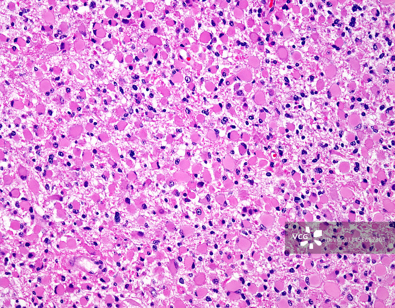 肥胖细胞型星形细胞瘤显微照片图片素材