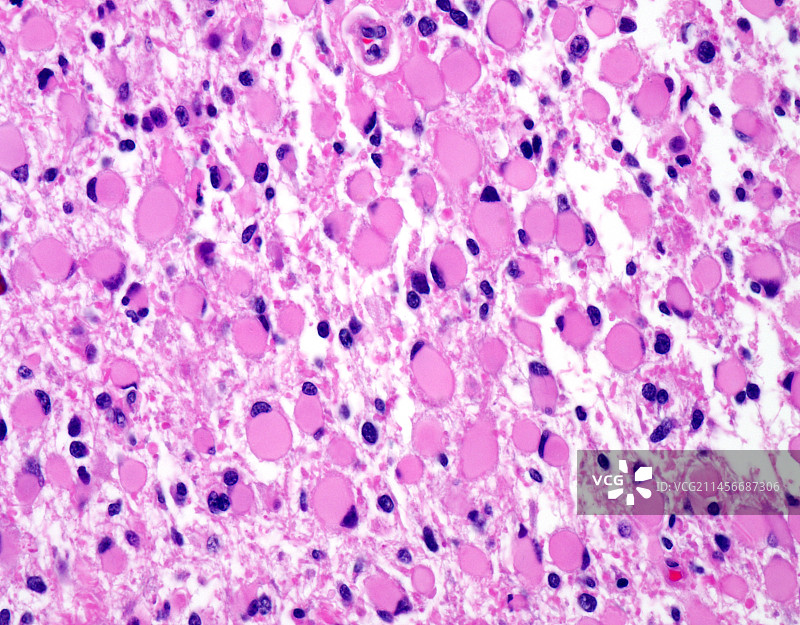 肥胖细胞型星形细胞瘤显微照片图片素材