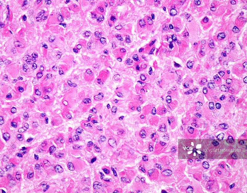 肥胖细胞型星形细胞瘤显微照片图片素材