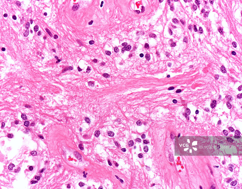 毛细胞星形胶质瘤显微照片图片素材