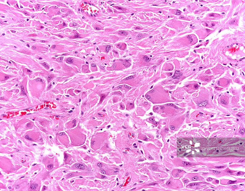 室管膜下巨细胞星形细胞瘤显微照片图片素材