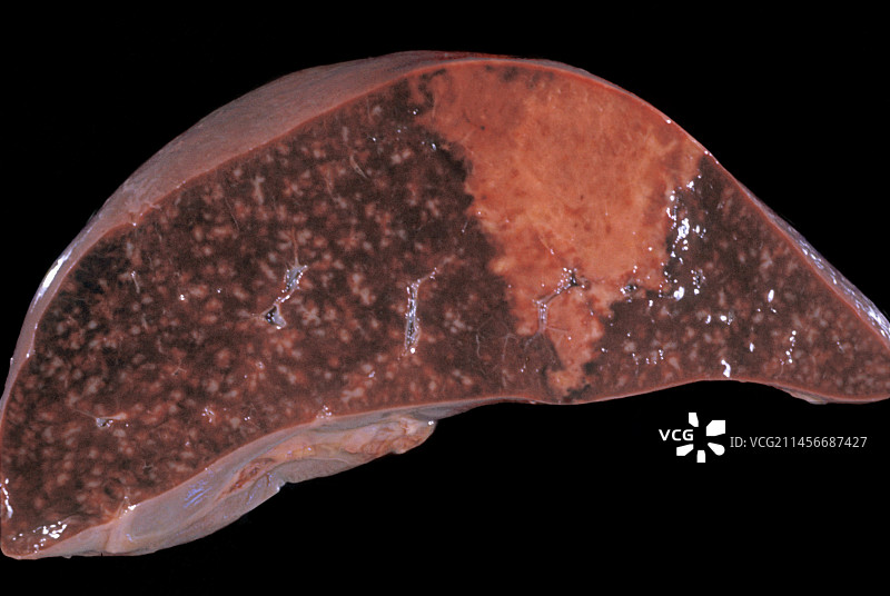 脾脏的贫血性梗死图片素材