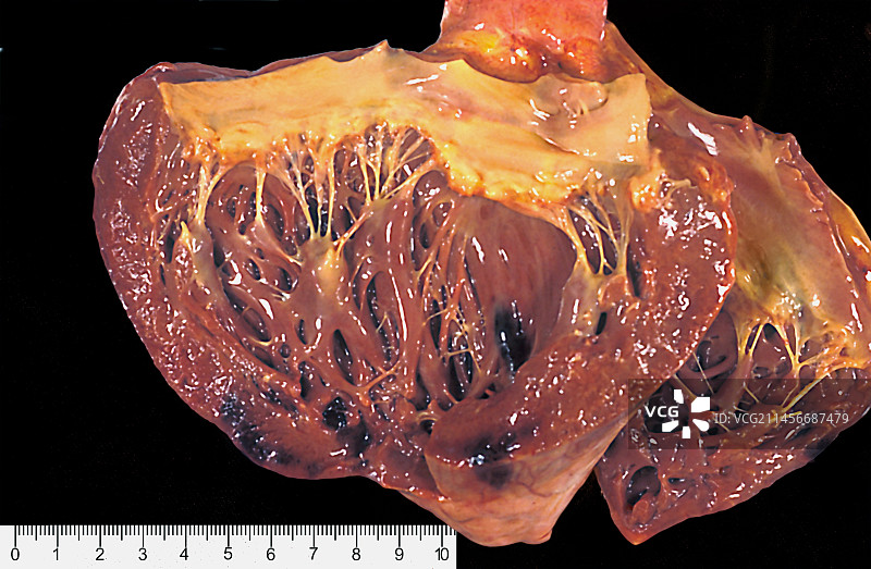 人的二尖瓣图片素材