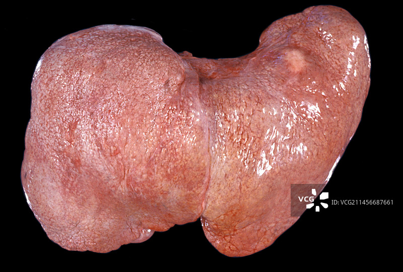 肝硬化图片素材