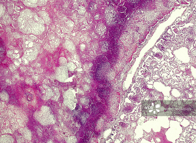 人类急性干酪性肺炎结核病显微照片图片素材