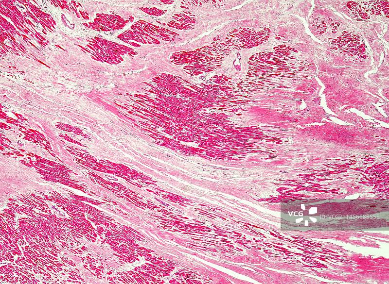 心肌纤维化浅显显微照片图片素材