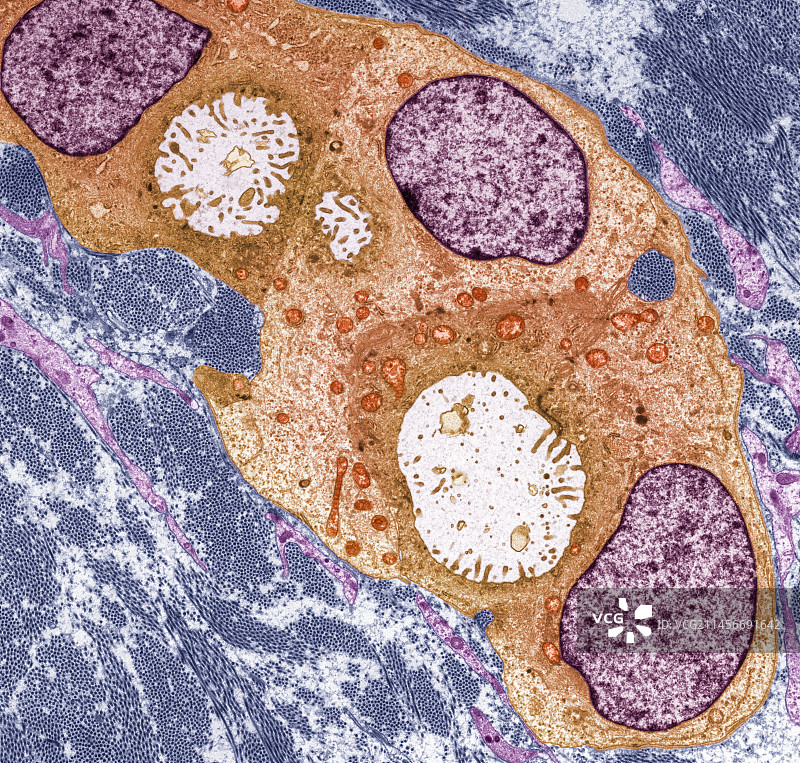 乳腺癌，TEM图片素材