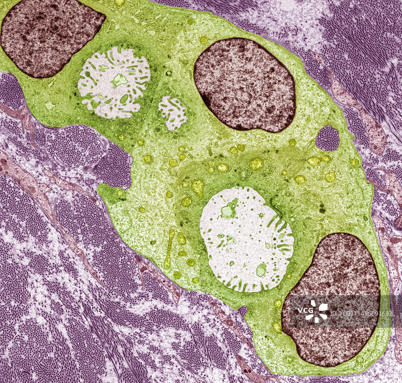 乳腺癌，TEM图片素材