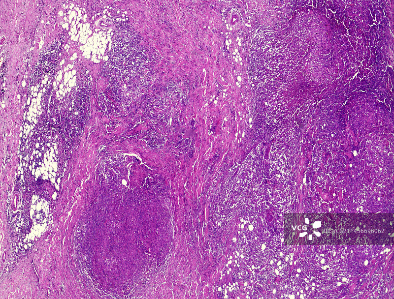 霍奇金淋巴瘤显微照片图片素材