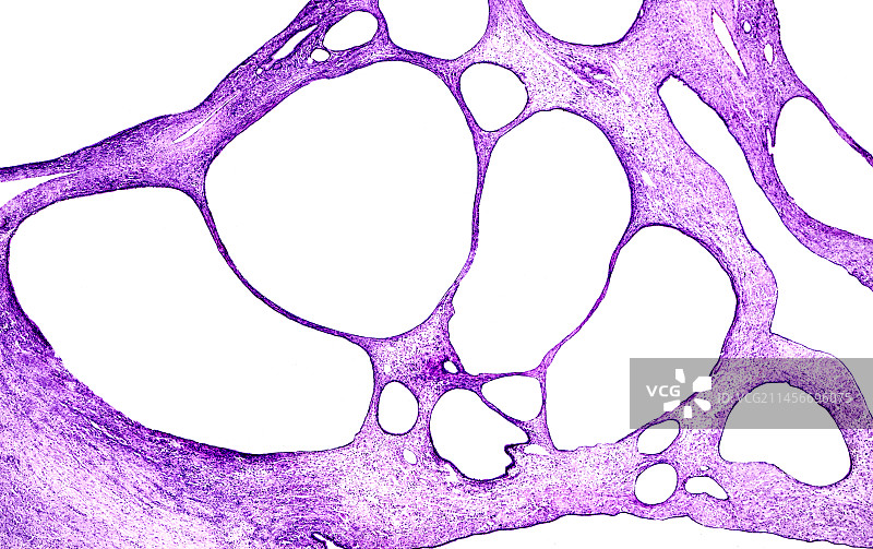 卵巢黏液性囊腺瘤显微照片图片素材