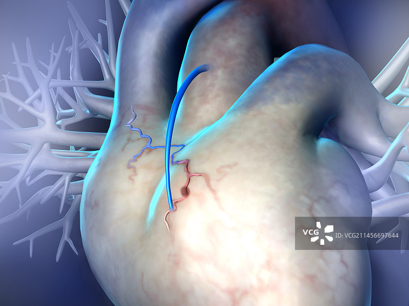 心脏搭桥移植术插图图片素材